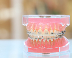 歯の生え変わりを考慮 治療方法の選択