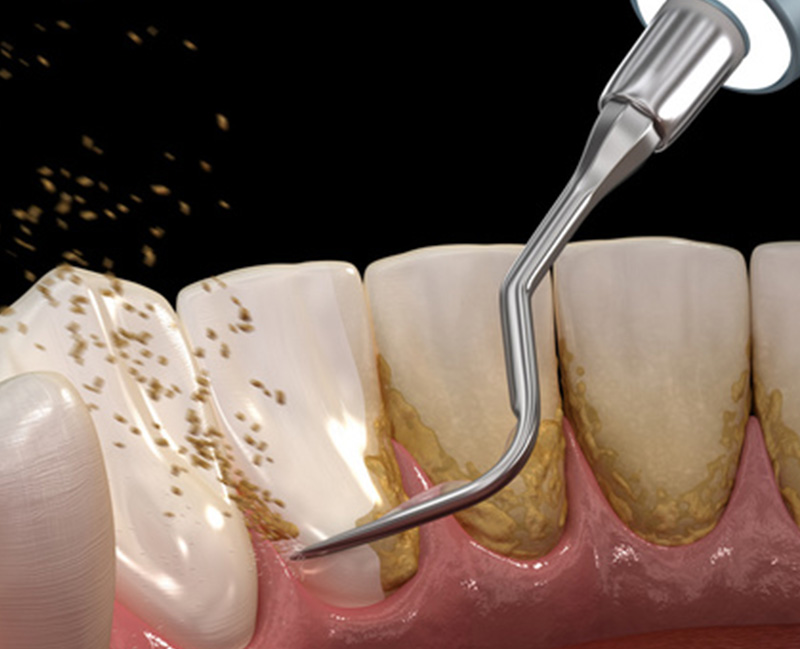 歯周組織を切り開く外科的処置で治療